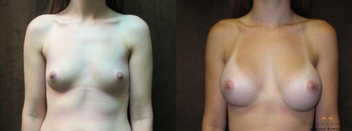 Before & After Breast Augmentation Case 58 View #3 View in Fort Worth, Texas