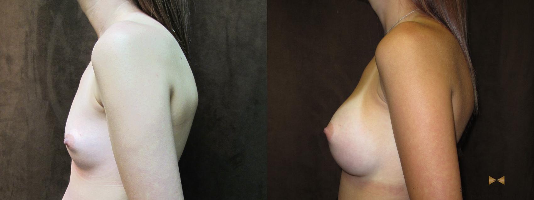 Before & After Breast Augmentation Case 58 View #4 View in Fort Worth, Texas