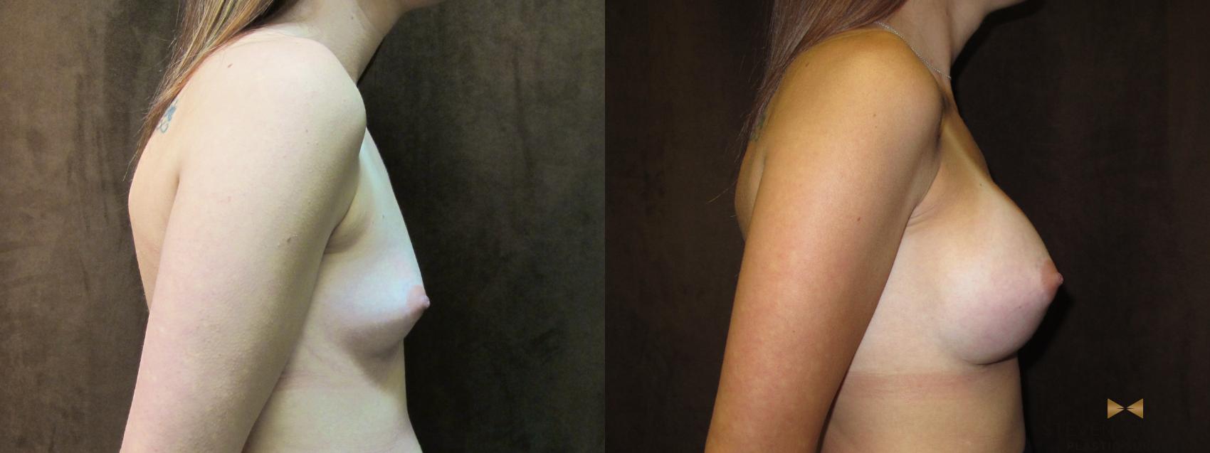 Before & After Breast Augmentation Case 58 View #5 View in Fort Worth, Texas