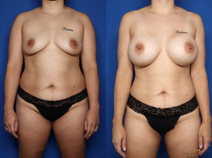 Before & After Breast Augmentation Case 586 Front View in Fort Worth & Arlington, Texas