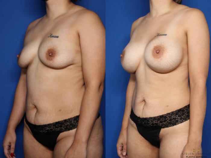 Before & After Breast Augmentation Case 586 Left Oblique View in Fort Worth & Arlington, Texas
