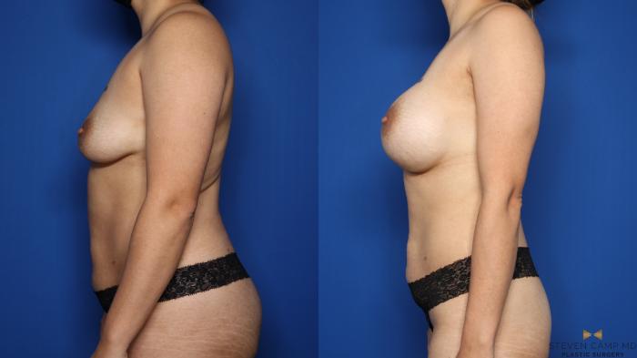 Before & After Breast Augmentation Case 586 Left Side View in Fort Worth & Arlington, Texas