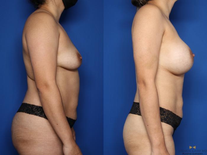 Before & After Breast Augmentation Case 586 Right Side View in Fort Worth & Arlington, Texas