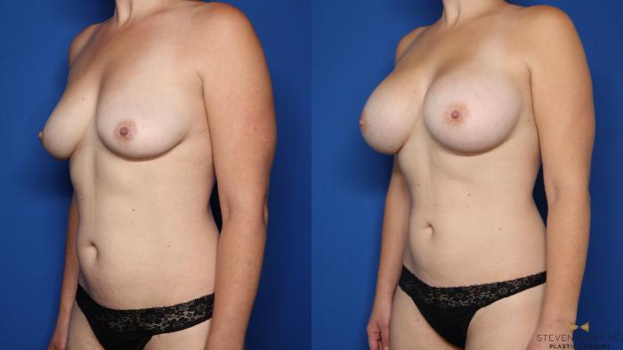Before & After Breast Augmentation Case 588 Left Oblique View in Fort Worth & Arlington, Texas