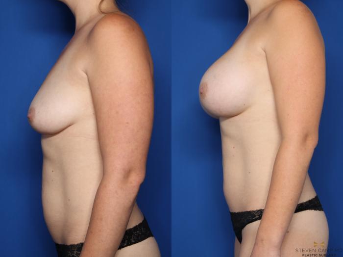 Before & After Breast Augmentation Case 588 Left Side View in Fort Worth & Arlington, Texas