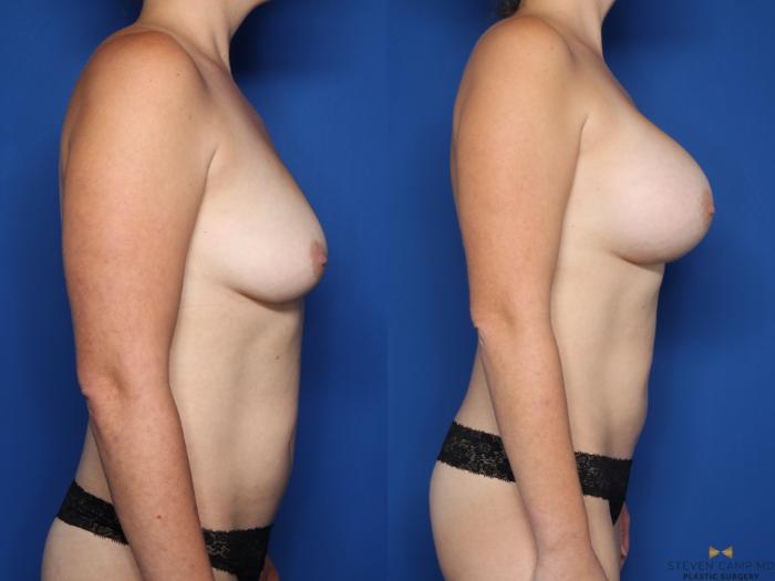 Before & After Breast Augmentation Case 588 Right Side View in Fort Worth & Arlington, Texas
