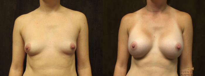 Before & After Breast Augmentation Case 59 View #2 View in Fort Worth, Texas