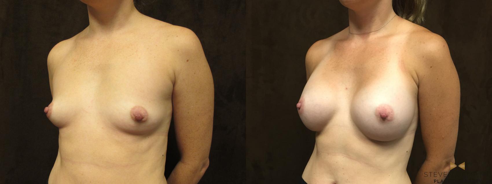 Breast Augmentation Before & After Photo | Fort Worth, Texas | Steven Camp MD Plastic Surgery