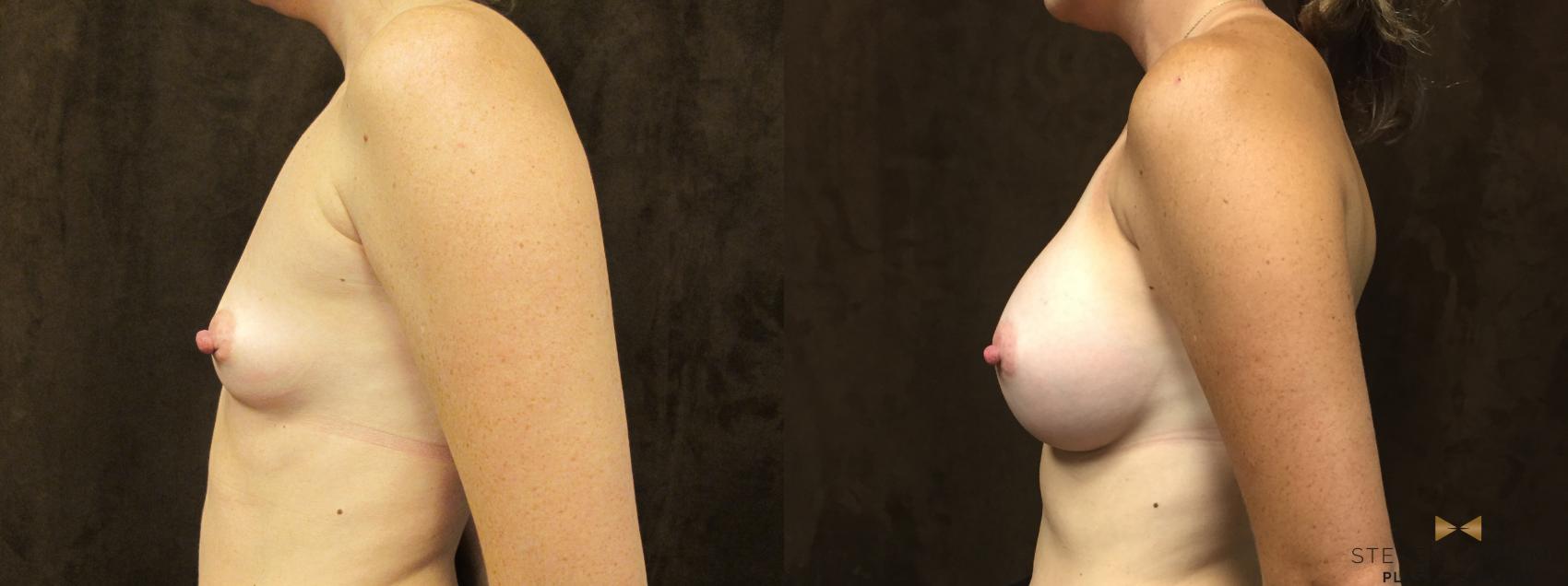 Before & After Breast Augmentation Case 59 View #4 View in Fort Worth, Texas