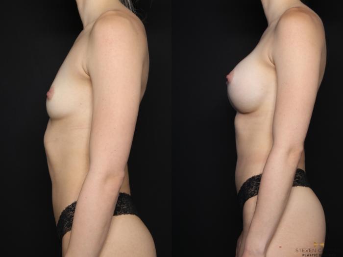 Before & After Breast Augmentation Case 601 Left Side View in Fort Worth, Texas