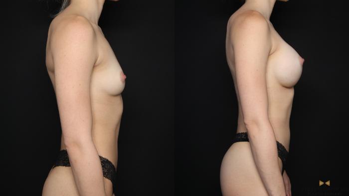 Before & After Breast Augmentation Case 601 Right Side View in Fort Worth, Texas