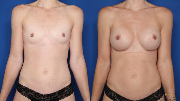 Before & After Breast Augmentation Case 607 Front View in Fort Worth & Arlington, Texas