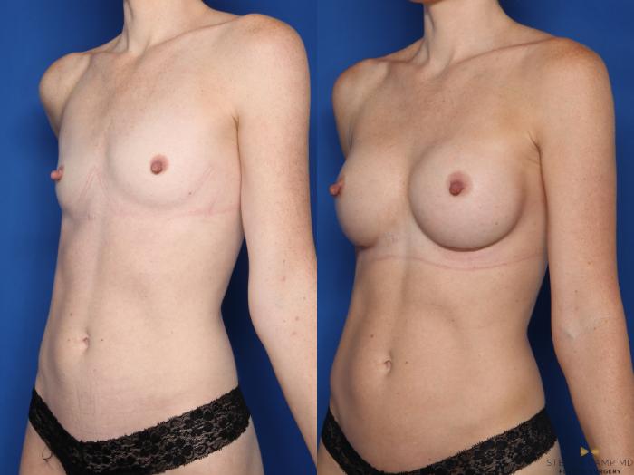 Before & After Breast Augmentation Case 607 Left Oblique View in Fort Worth & Arlington, Texas