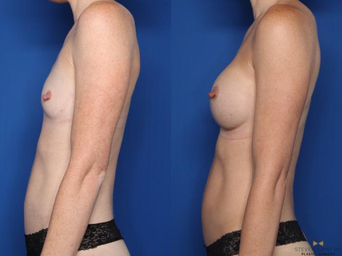 Before & After Breast Augmentation Case 607 Left Side View in Fort Worth & Arlington, Texas