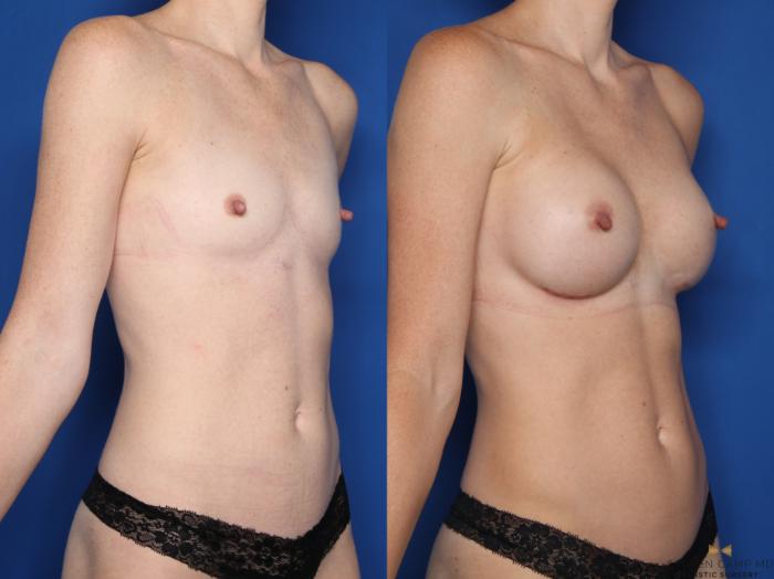 Before & After Breast Augmentation Case 607 Right Oblique View in Fort Worth & Arlington, Texas
