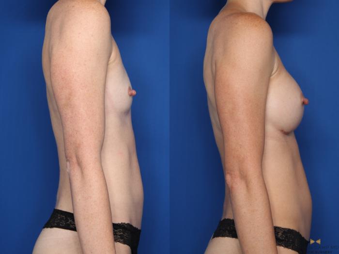 Before & After Breast Augmentation Case 607 Right Side View in Fort Worth & Arlington, Texas