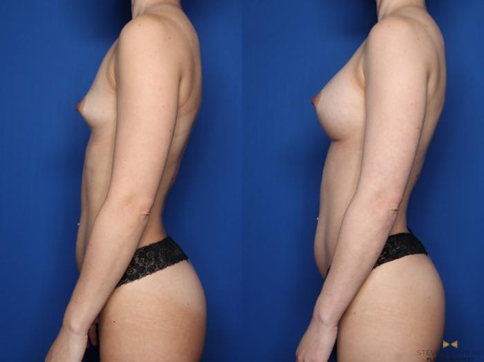 Before & After Breast Augmentation Case 617 Left Side View in Fort Worth & Arlington, Texas