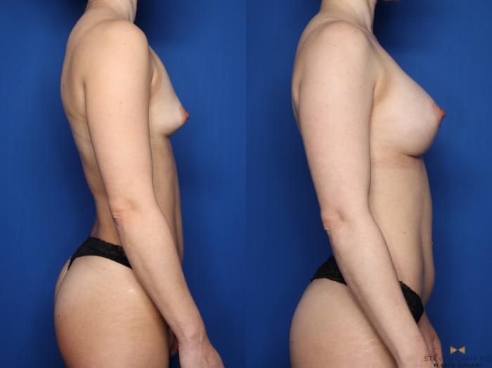 Before & After Breast Augmentation Case 617 Right Side View in Fort Worth & Arlington, Texas
