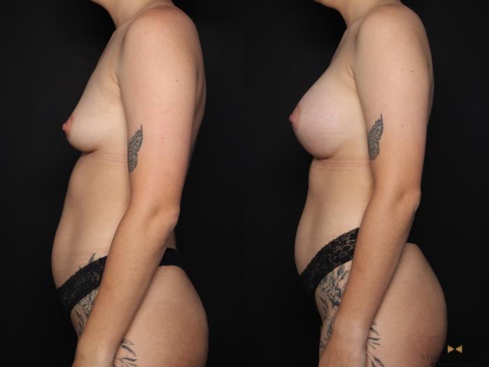 Before & After Breast Augmentation Case 625 Left Side View in Fort Worth & Arlington, Texas