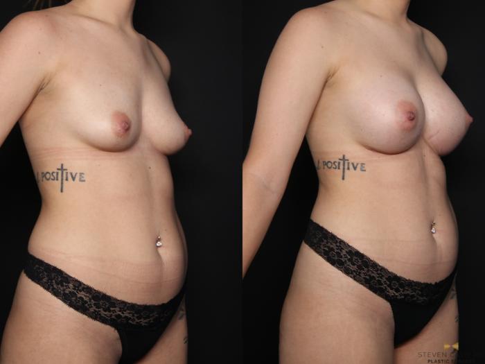 Before & After Breast Augmentation Case 625 Right Oblique View in Fort Worth & Arlington, Texas
