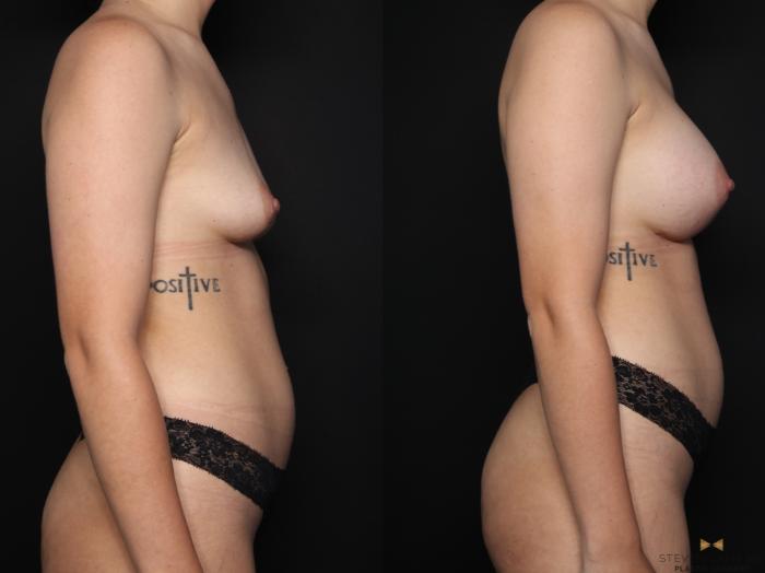 Before & After Breast Augmentation Case 625 Right Side View in Fort Worth & Arlington, Texas