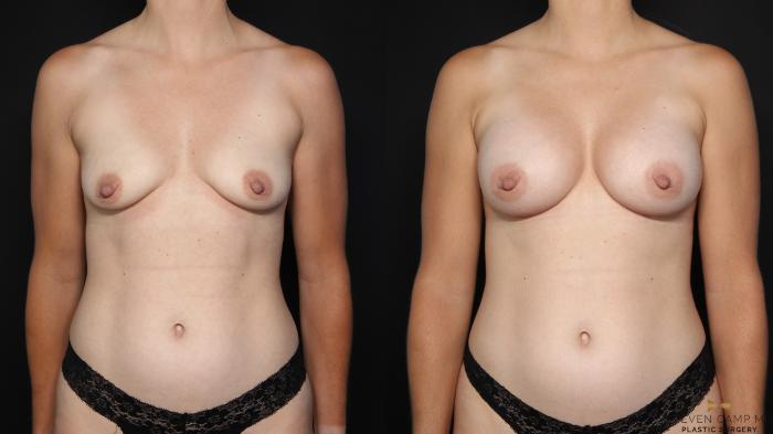 Before & After Breast Augmentation Case 630 Front View in Fort Worth & Arlington, Texas