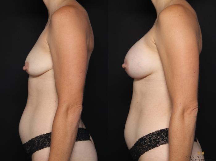 Before & After Breast Augmentation Case 630 Left Side View in Fort Worth & Arlington, Texas