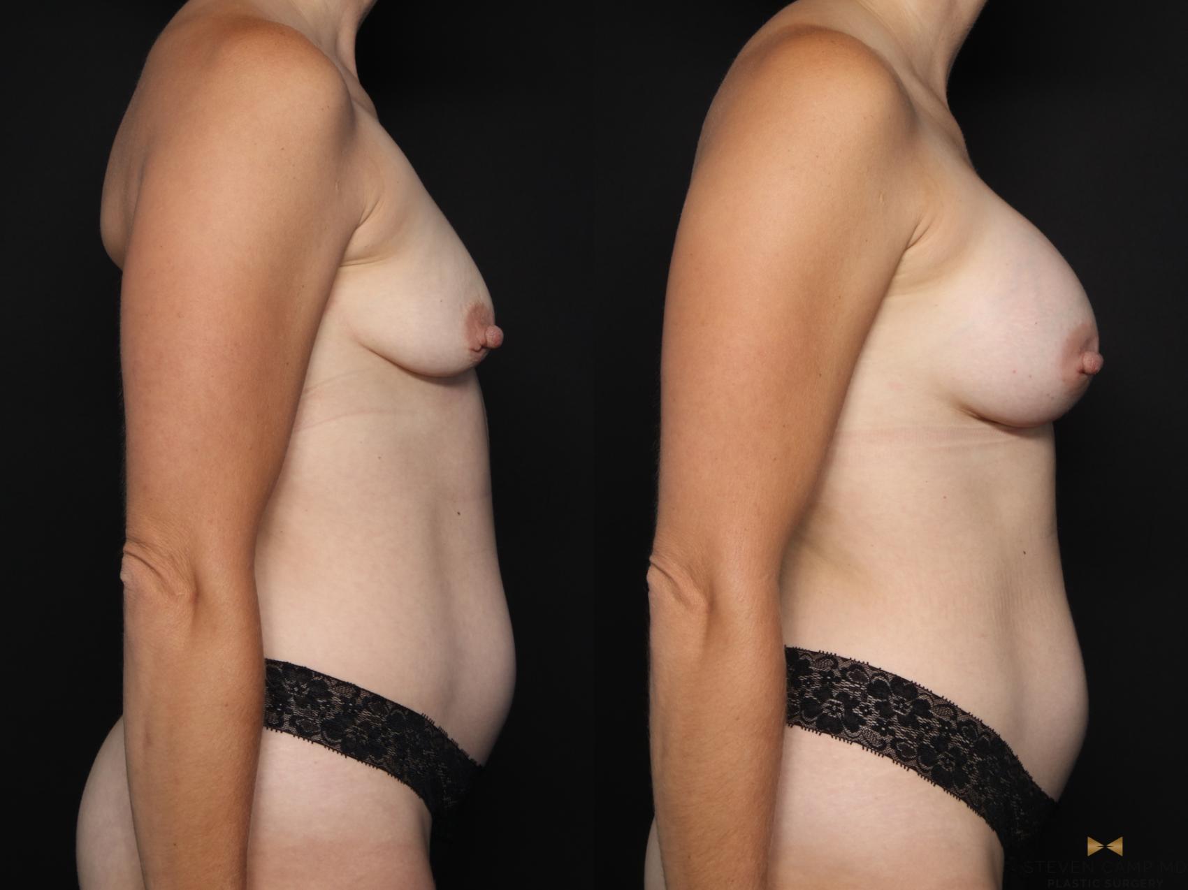 Before & After Breast Augmentation Case 630 Right Side View in Fort Worth & Arlington, Texas