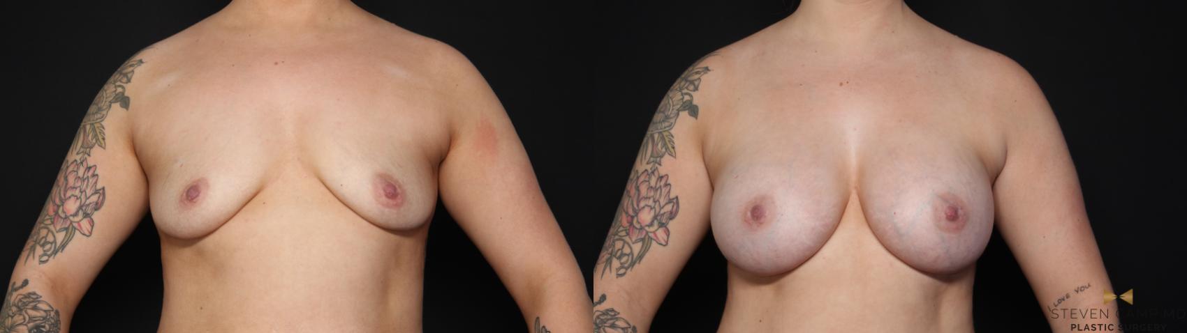 Before & After Breast Augmentation Case 634 Front View in Fort Worth & Arlington, Texas