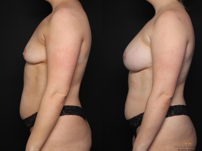 Before & After Breast Augmentation Case 634 Left Side View in Fort Worth & Arlington, Texas