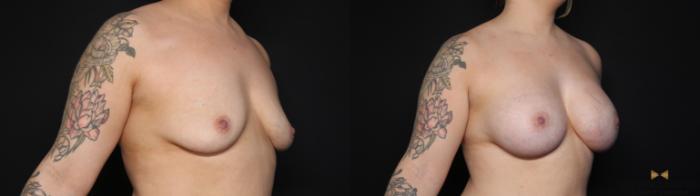 Before & After Breast Augmentation Case 634 Right Oblique View in Fort Worth & Arlington, Texas