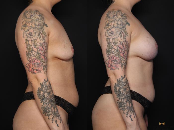 Before & After Breast Augmentation Case 634 Right Side View in Fort Worth & Arlington, Texas
