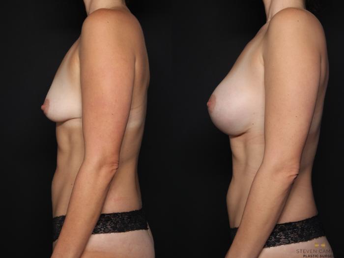 Before & After Breast Augmentation Case 640 Left Side View in Fort Worth & Arlington, Texas