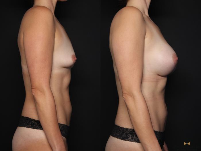 Before & After Breast Augmentation Case 640 Right Side View in Fort Worth & Arlington, Texas