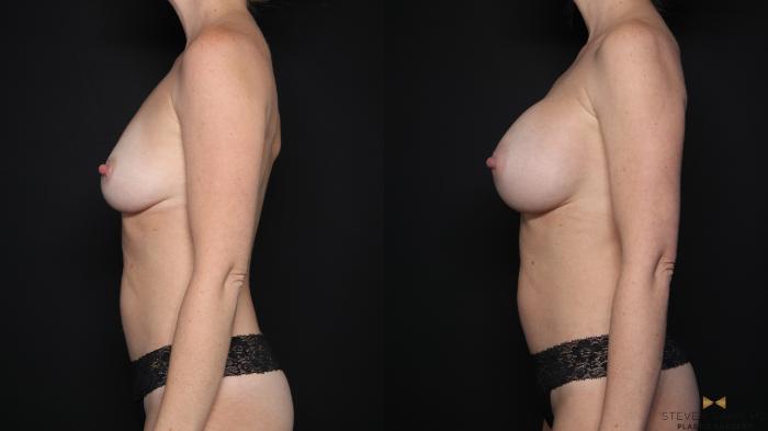 Before & After Breast Augmentation Case 646 Left Side View in Fort Worth & Arlington, Texas