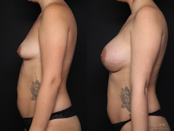 Before & After Breast Augmentation Case 647 Left Side View in Fort Worth & Arlington, Texas