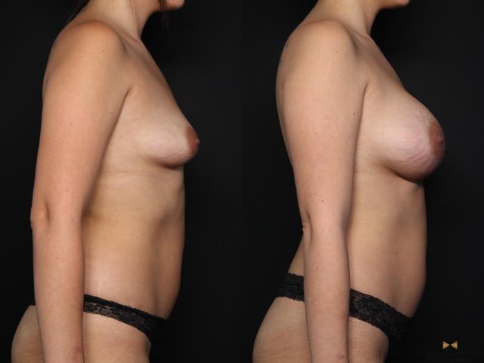 Before & After Breast Augmentation Case 647 Right Side View in Fort Worth & Arlington, Texas