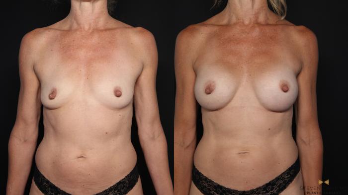 Before & After Breast Augmentation Case 652 Front View in Fort Worth & Arlington, Texas