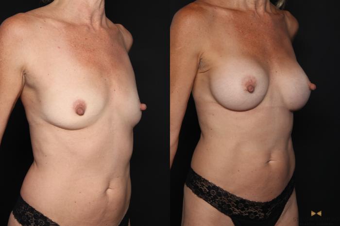 Before & After Breast Augmentation Case 652 Right Oblique View in Fort Worth & Arlington, Texas