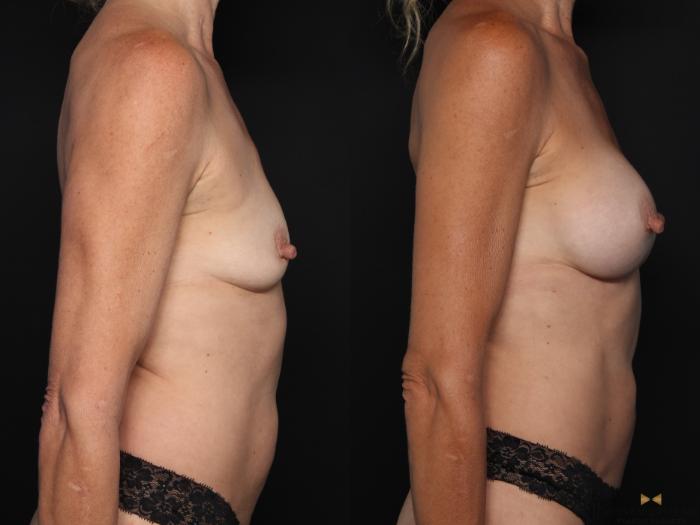 Before & After Breast Augmentation Case 652 Right Side View in Fort Worth & Arlington, Texas