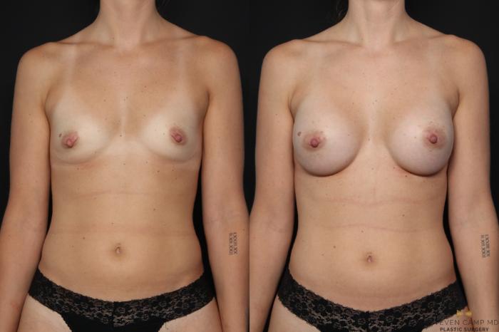 Before & After Breast Augmentation Case 655 Front View in Fort Worth & Arlington, Texas