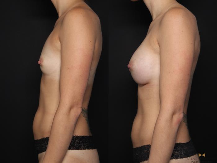 Before & After Breast Augmentation Case 655 Left Side View in Fort Worth & Arlington, Texas