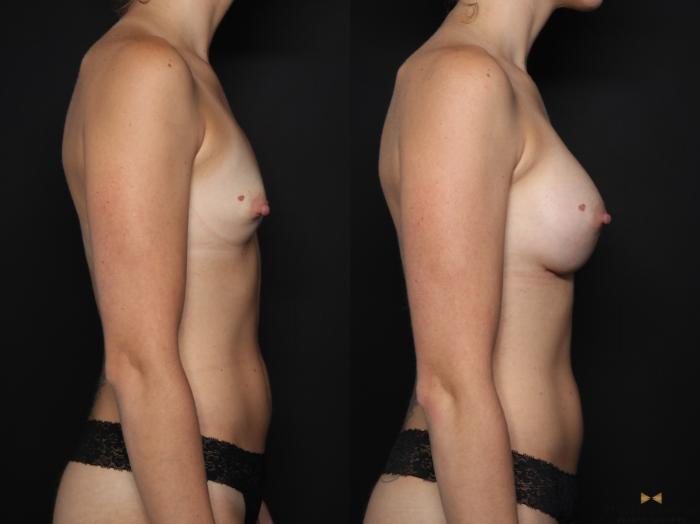 Before & After Breast Augmentation Case 655 Right Side View in Fort Worth & Arlington, Texas