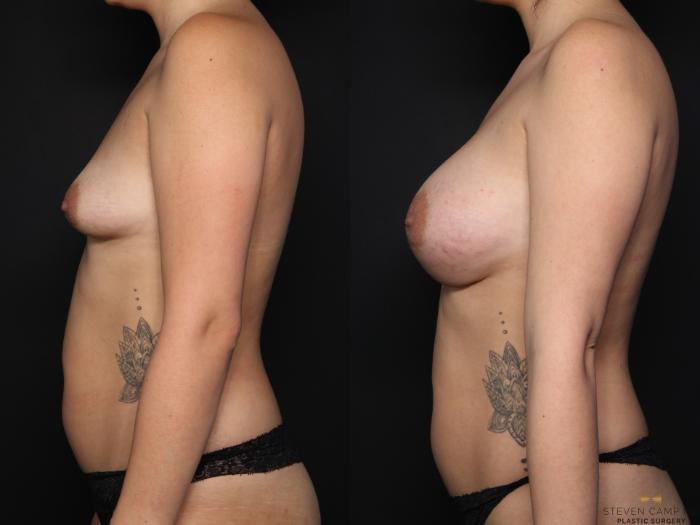 Before & After Breast Augmentation Case 658 Left Side View in Fort Worth & Arlington, Texas