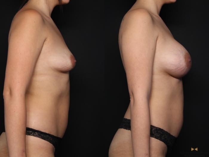 Before & After Breast Augmentation Case 658 Right Side View in Fort Worth & Arlington, Texas
