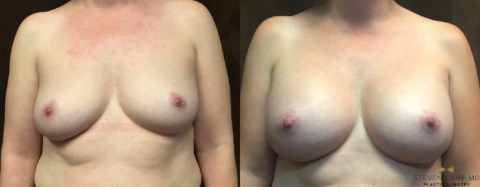 Before & After Breast Augmentation Case 66 View #1 View in Fort Worth & Arlington, Texas