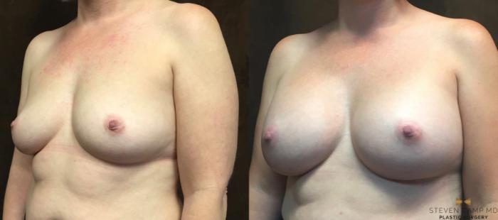 Before & After Breast Augmentation Case 66 View #2 View in Fort Worth & Arlington, Texas