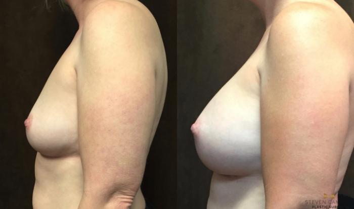 Before & After Breast Augmentation Case 66 View #3 View in Fort Worth & Arlington, Texas