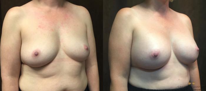Before & After Breast Augmentation Case 66 View #4 View in Fort Worth & Arlington, Texas