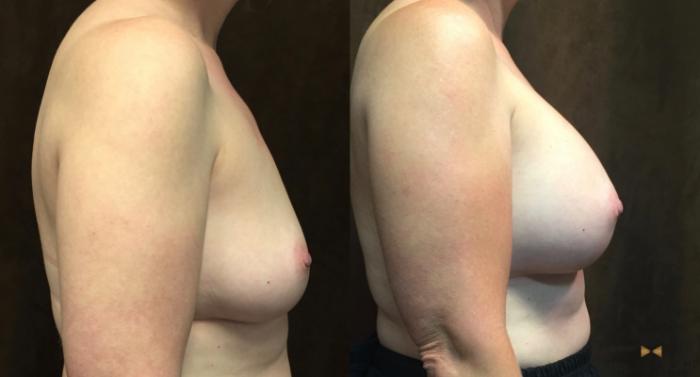 Before & After Breast Augmentation Case 66 View #5 View in Fort Worth & Arlington, Texas
